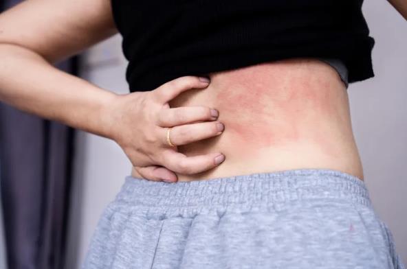 How Long Do Chronic Spontaneous Urticaria Symptoms Last?